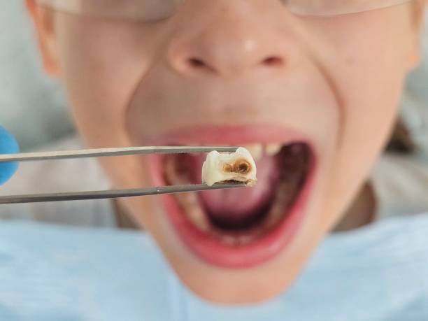 Best Emergency Dental Care for Abscessed Tooth in Gainesville, TX